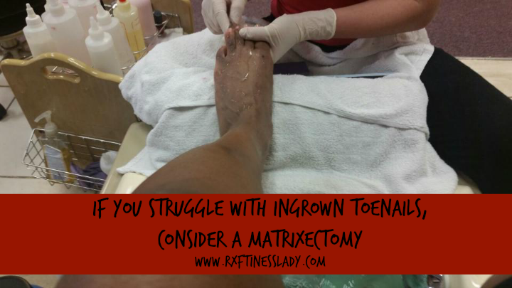 If You Struggle With Ingrown ToeNails, Consider A Matrixectomy
